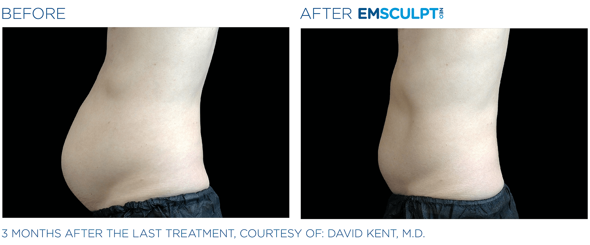 Emsculpt Neo® In Fort Lauderdale Fl Eric Wilkerson