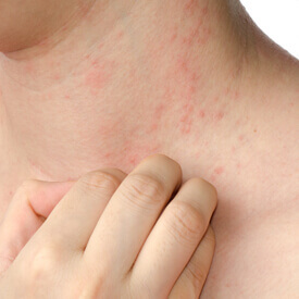 Eczema 